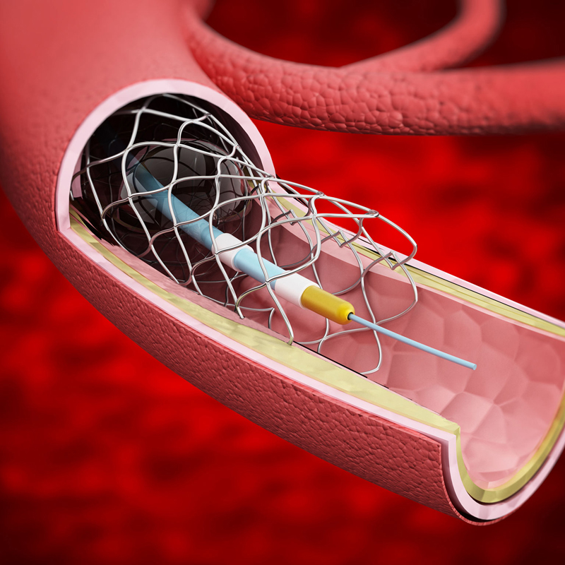 Vascular surgery