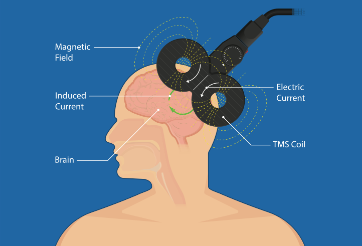 Transcranial-Magnetic-Stimulation-TMS